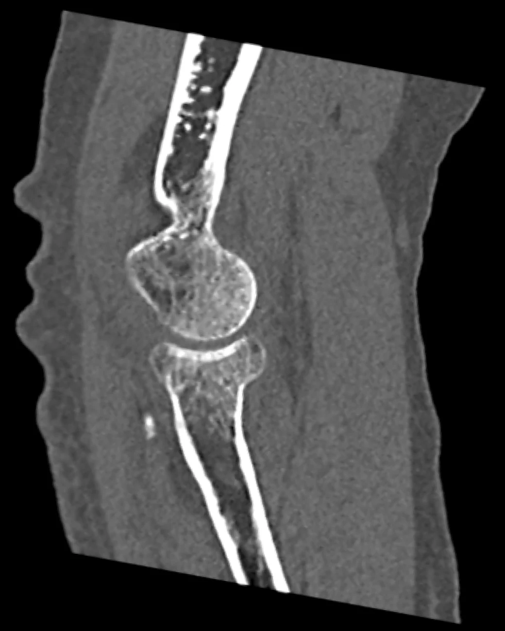Sagittale CT-Rekonstruktion des Ellenbogens im Knochenfenster: Radiusköpfchen und angrenzendes Oberarmköpfchen wirken auf den ersten Blick unauffällig, die Einstauchung ist kaum abgrenzbar.