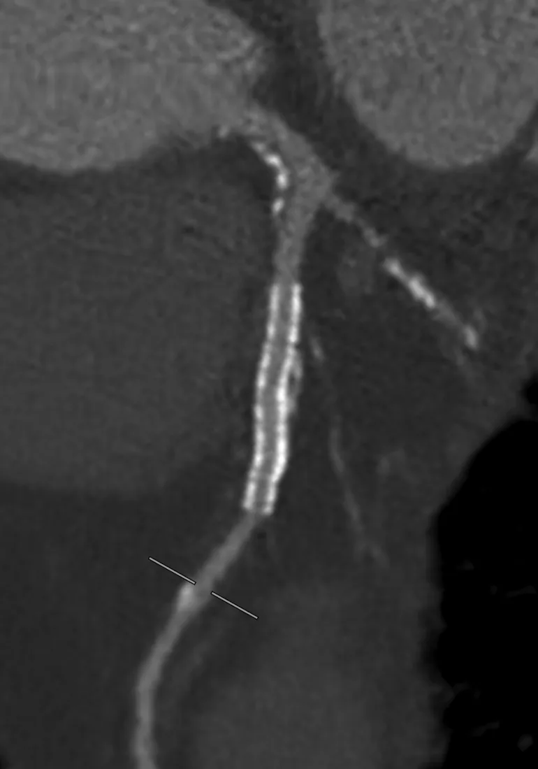 Herz-CT, Längsschnitt eines Herzkranzgefäßes: Der einliegende Stent zeichnet sich als röhrenförmiges Gittergeflecht ab, das Gefäßinnere darin ist zu erkennen.