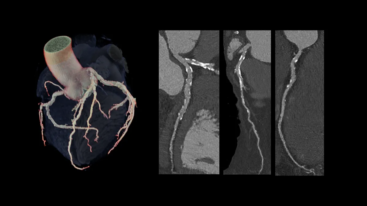 Koronar-CT-Angiographie – Darstellung verkalkter Ablagerungen in den Herzkranzgefäßen am Wide-Detector-CT.