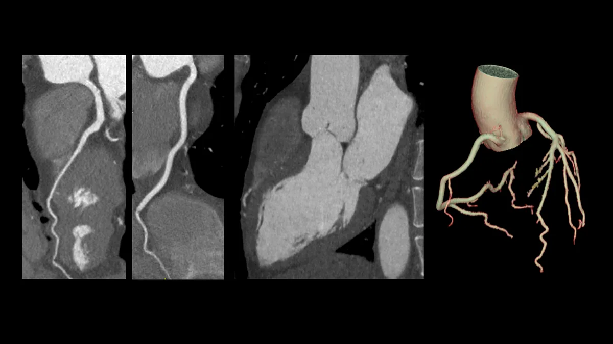 Herz-CT-Angiographie: dreidimensionale Darstellung der Herzkranzgefäße (TrueFidelity Deep-Learning-Rekonstruktion).