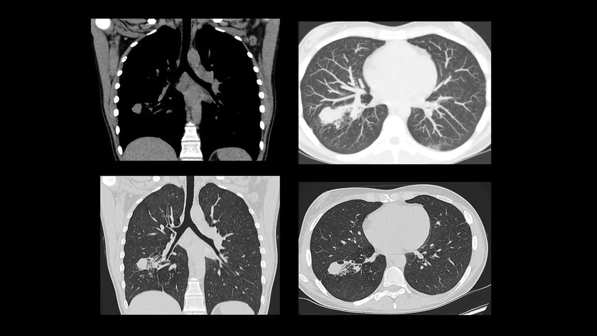 Niedrigdosis-Thorax-CT mit Darstellung eines peripheren Lungen­tumors.