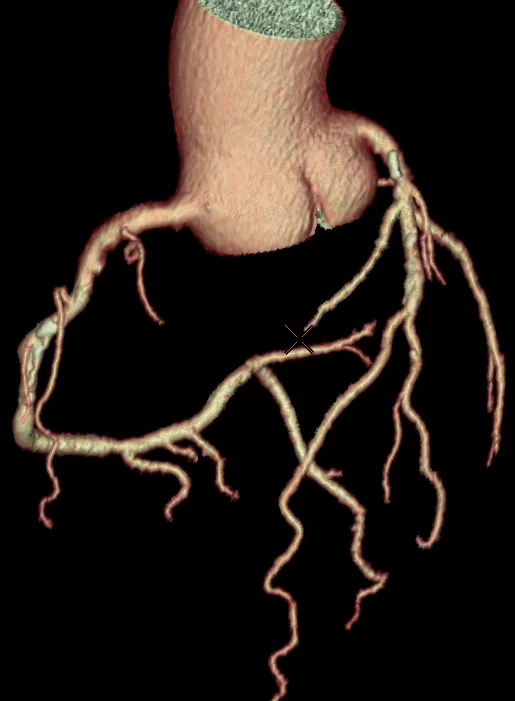 Dreidimensionales Cinematic-Rendering der Herzkranzgefäße aus einer Herz-CT – Hauptstamm, LAD, Ramus circumflexus und rechte Koronararterie auf der Aortenwurzel.