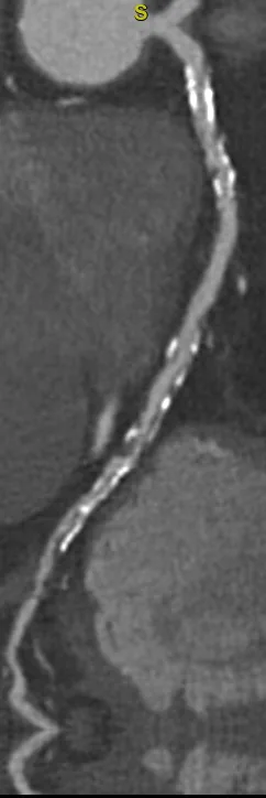 Herz-CT, cMPR eines Herzkranzgefäßes mit einliegendem Stent, markiert mit dem Buchstaben S.