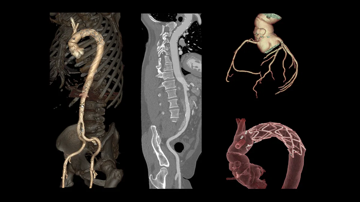 CT-Angiographie der Aorta und der zuführenden Gefäße – Gefäßdarstellung im Querschnitt.