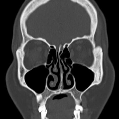 CT Nasennebenhöhlen