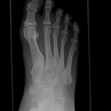 Röntgen Fuß